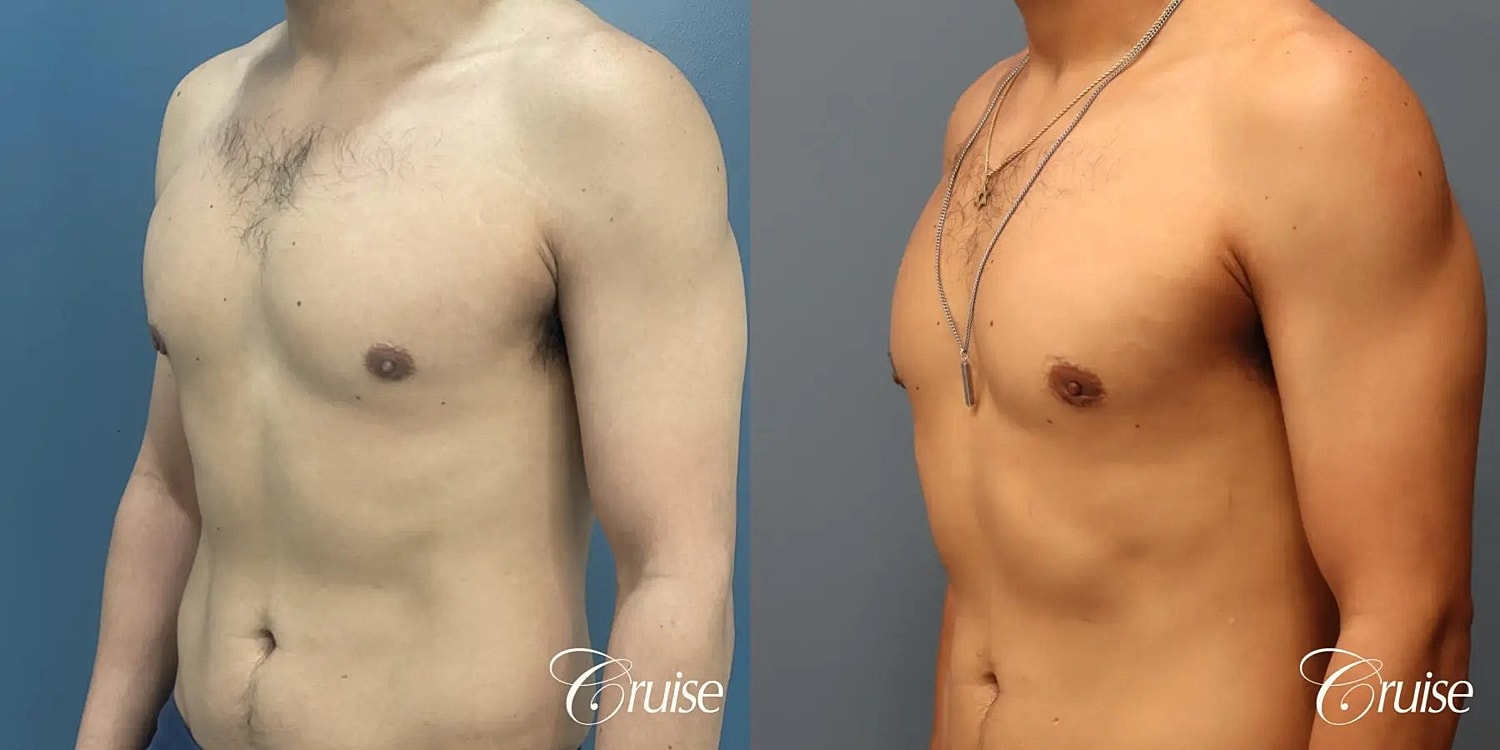 Gynecomastia Surgery Before & After