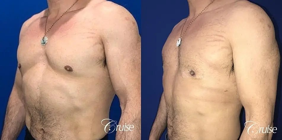 Gynecomastia Surgery Before & After