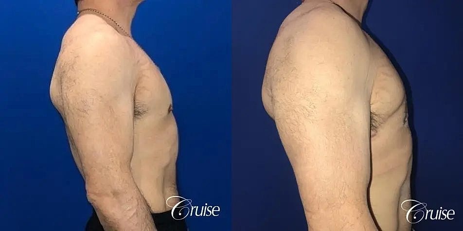 Gynecomastia Surgery Before & After