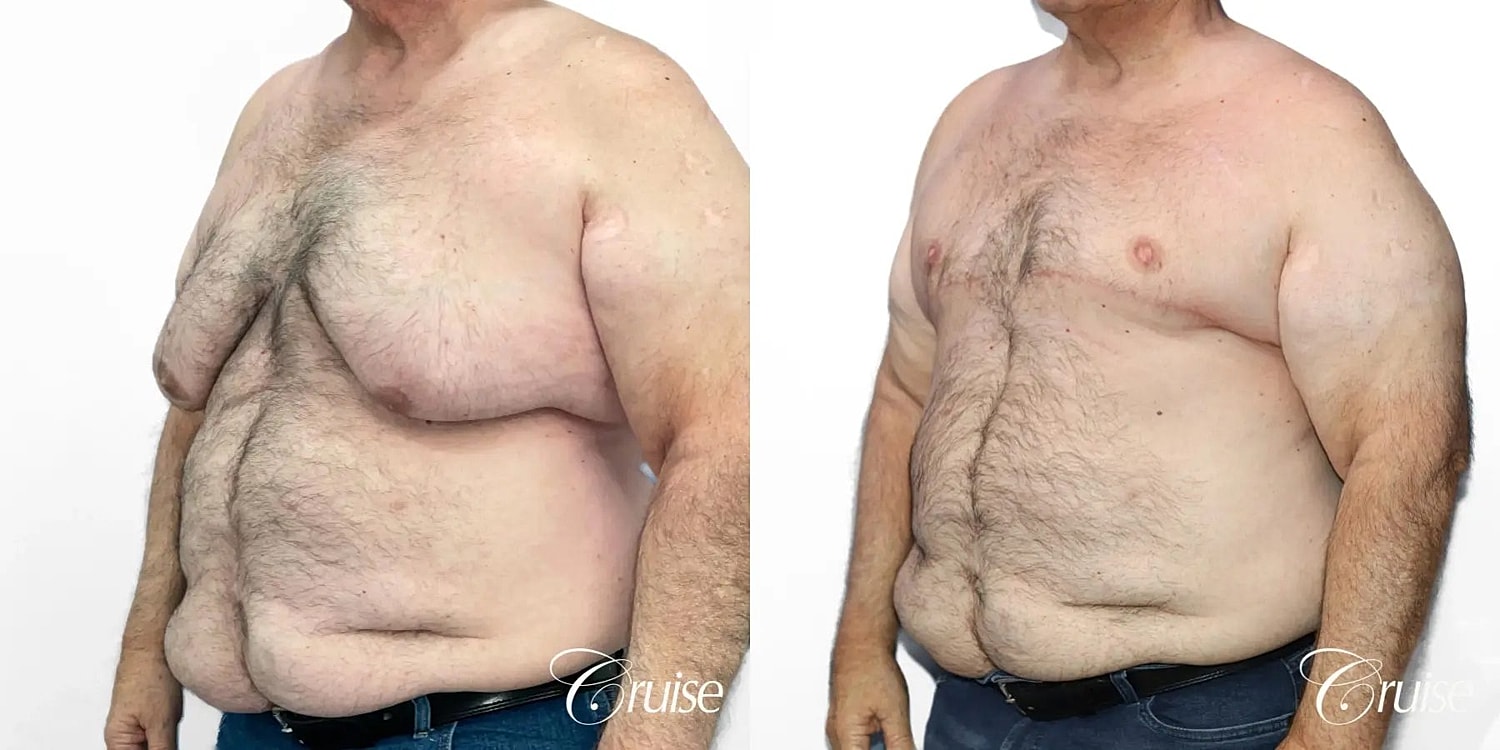 Gynecomastia Surgery Before & After