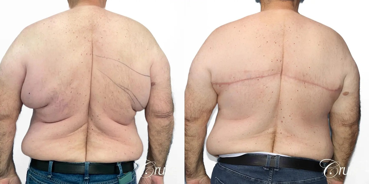 Gynecomastia Surgery Before & After