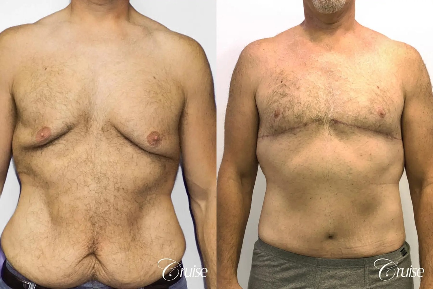 Gynecomastia Surgery Before & After