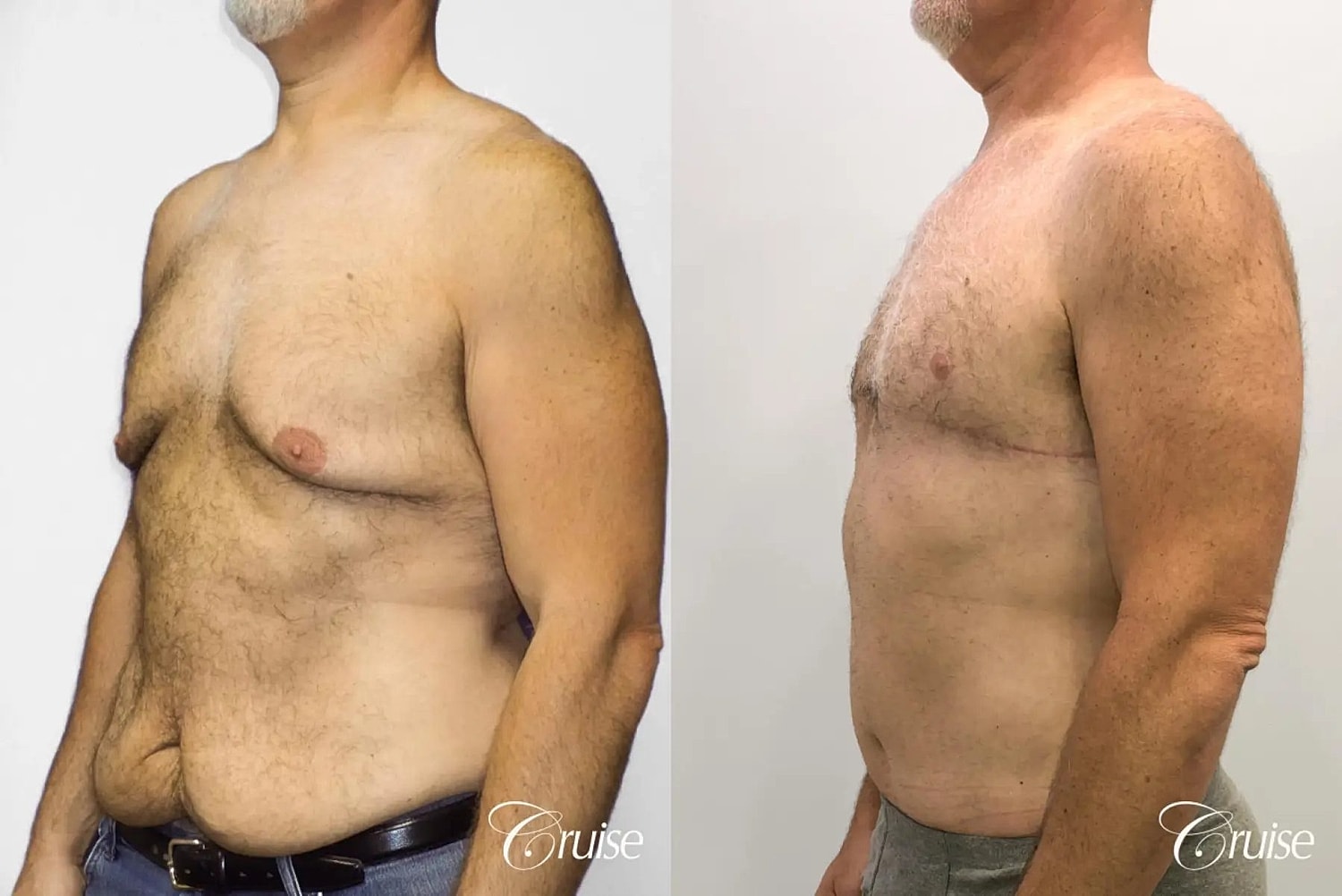 Gynecomastia Surgery Before & After
