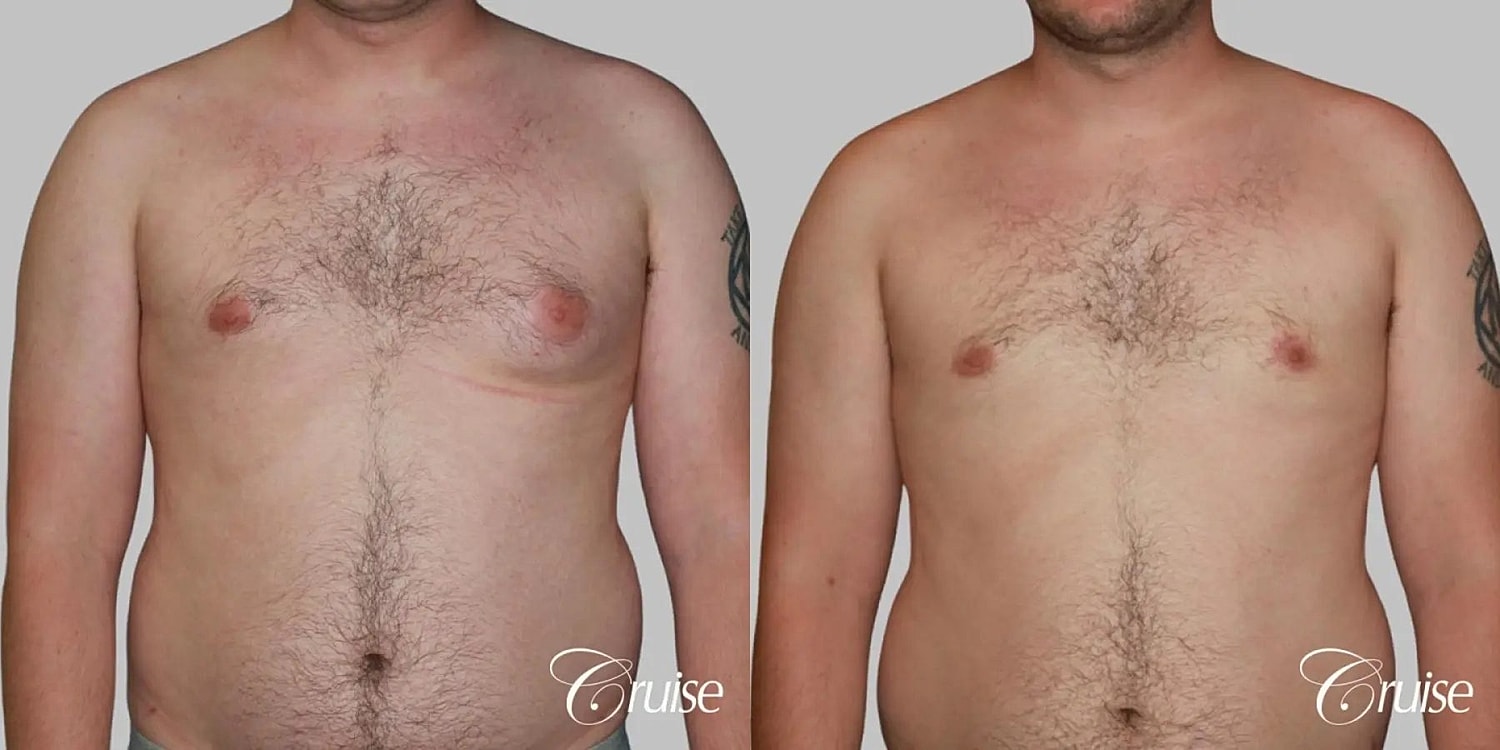 Gynecomastia Surgery Before & After
