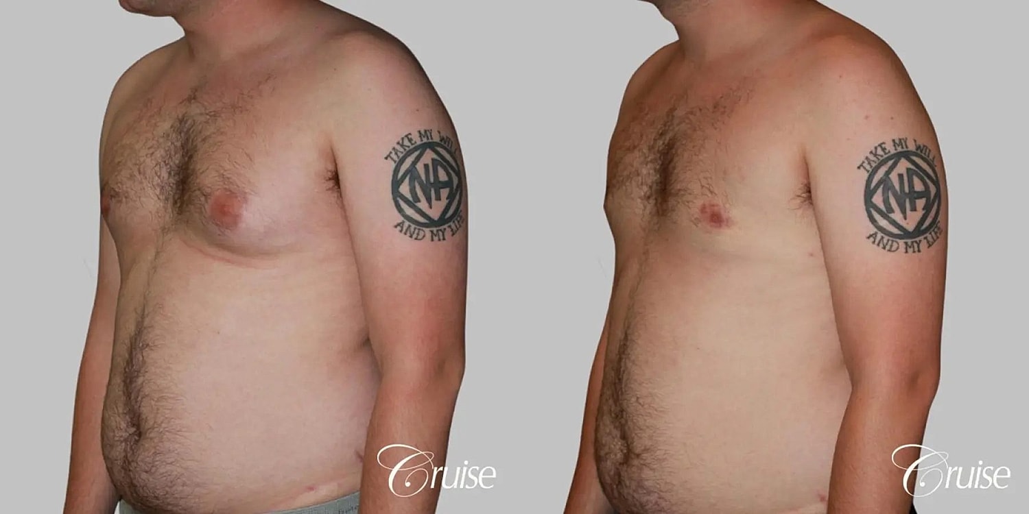 Gynecomastia Surgery Before & After