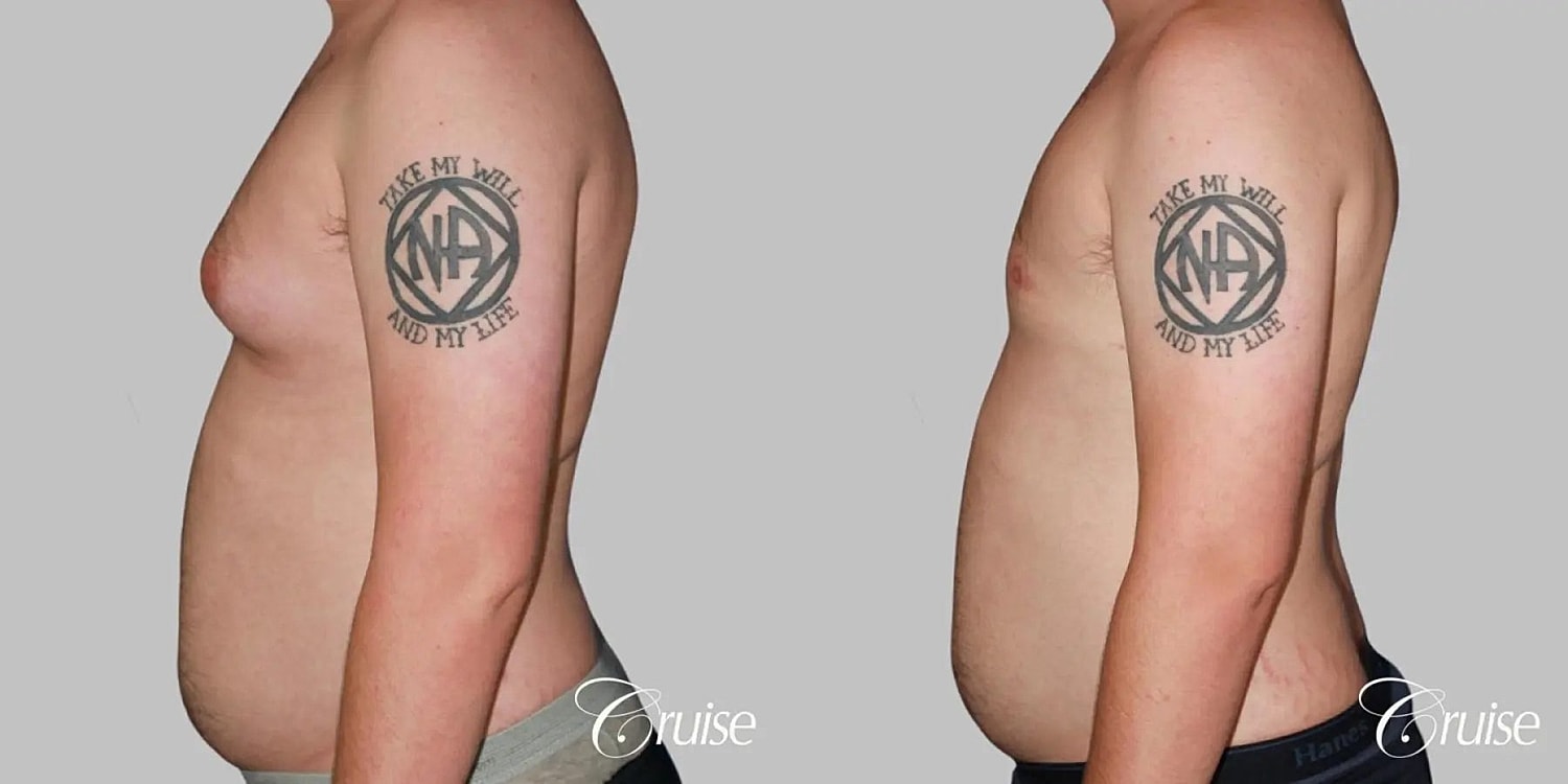 Gynecomastia Surgery Before & After