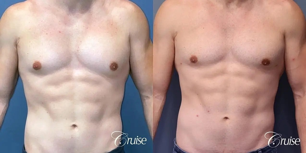 Gynecomastia Surgery Before & After