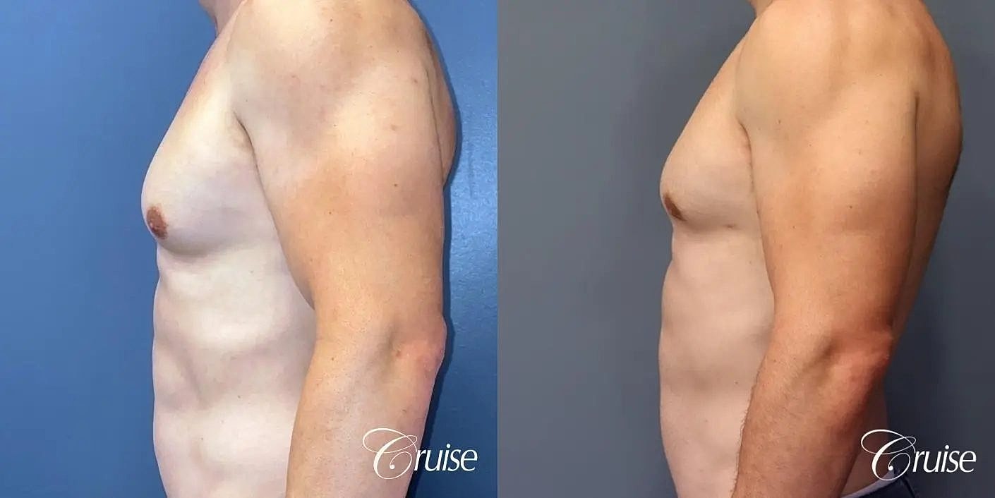 Gynecomastia Surgery Before & After