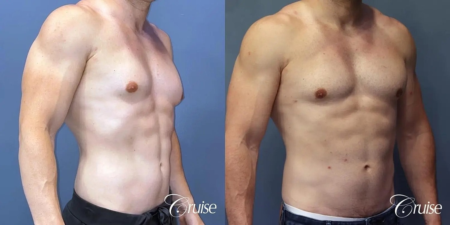 Gynecomastia Surgery Before & After
