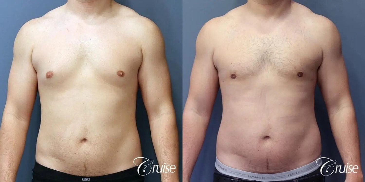 Gynecomastia Surgery Before & After