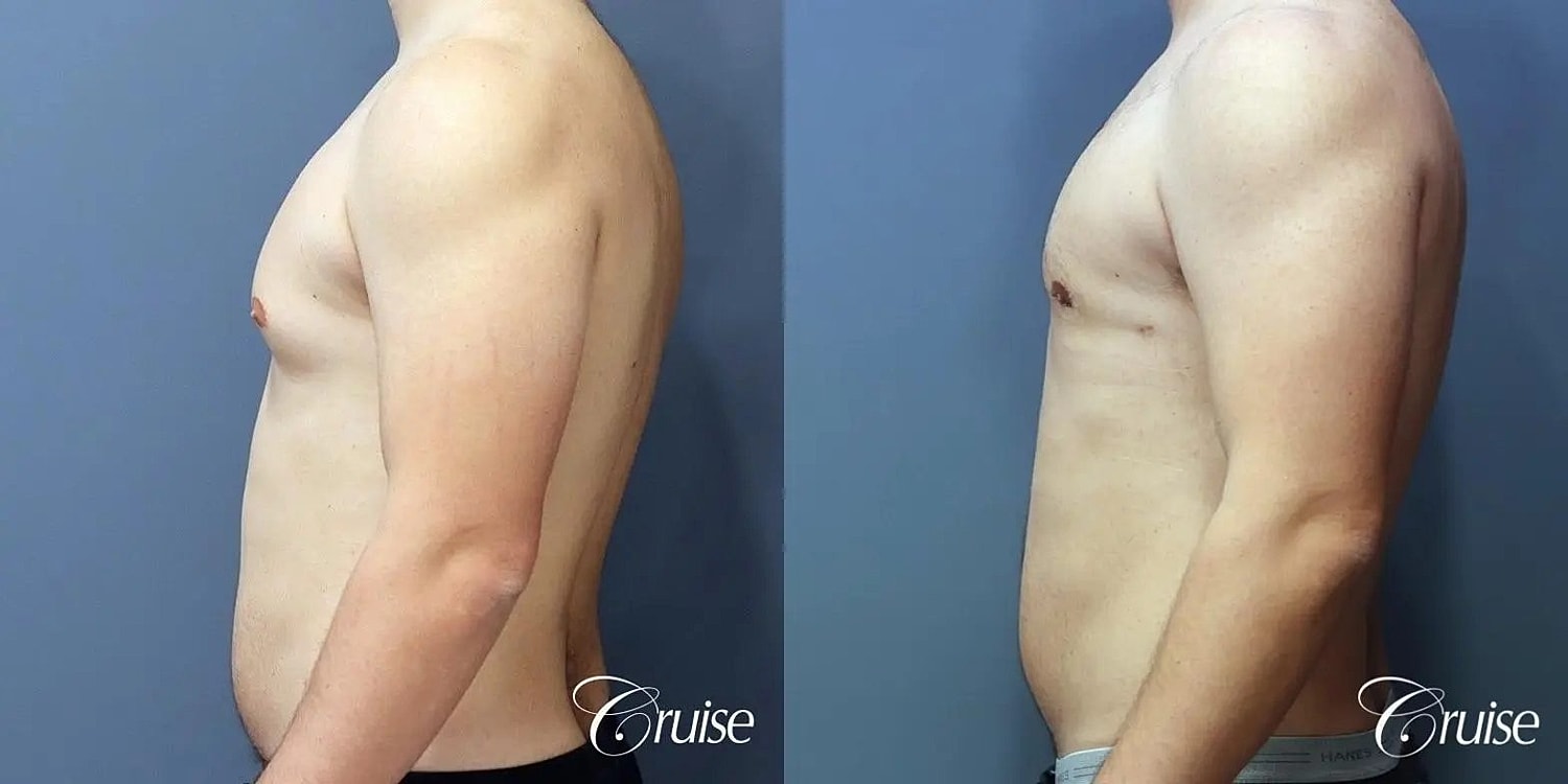 Gynecomastia Surgery Before & After