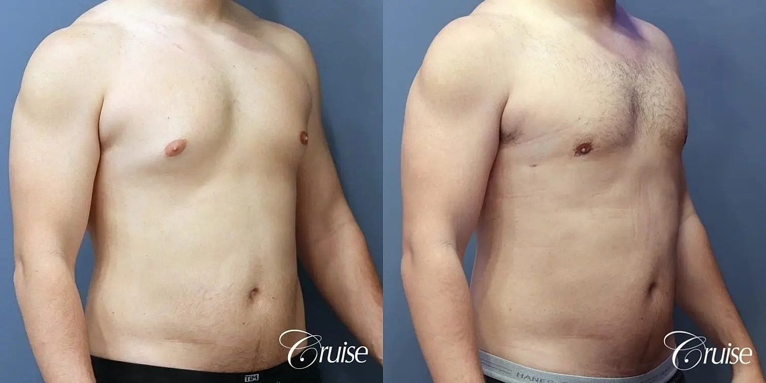 Gynecomastia Surgery Before & After