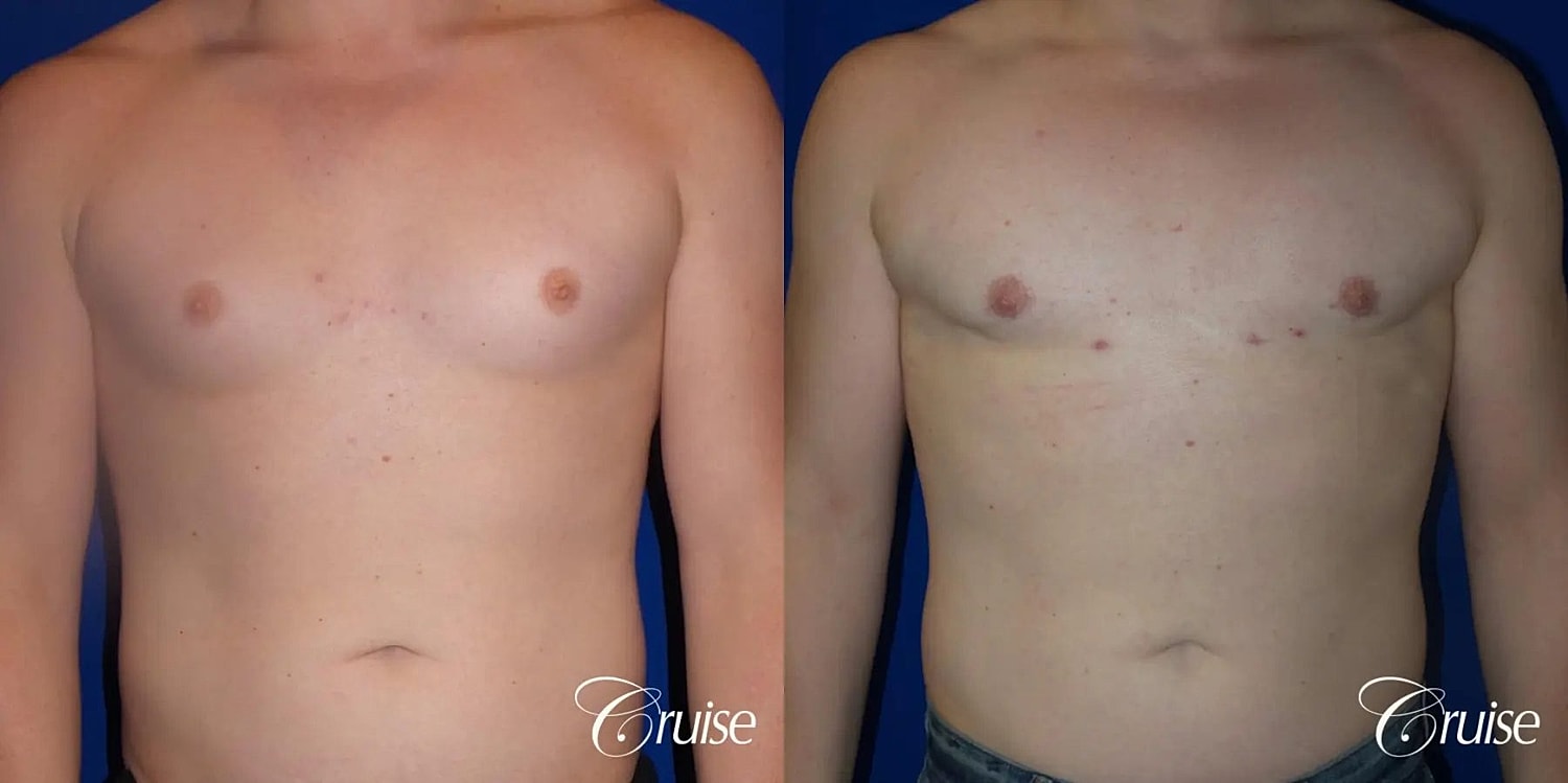 Gynecomastia Surgery Before & After