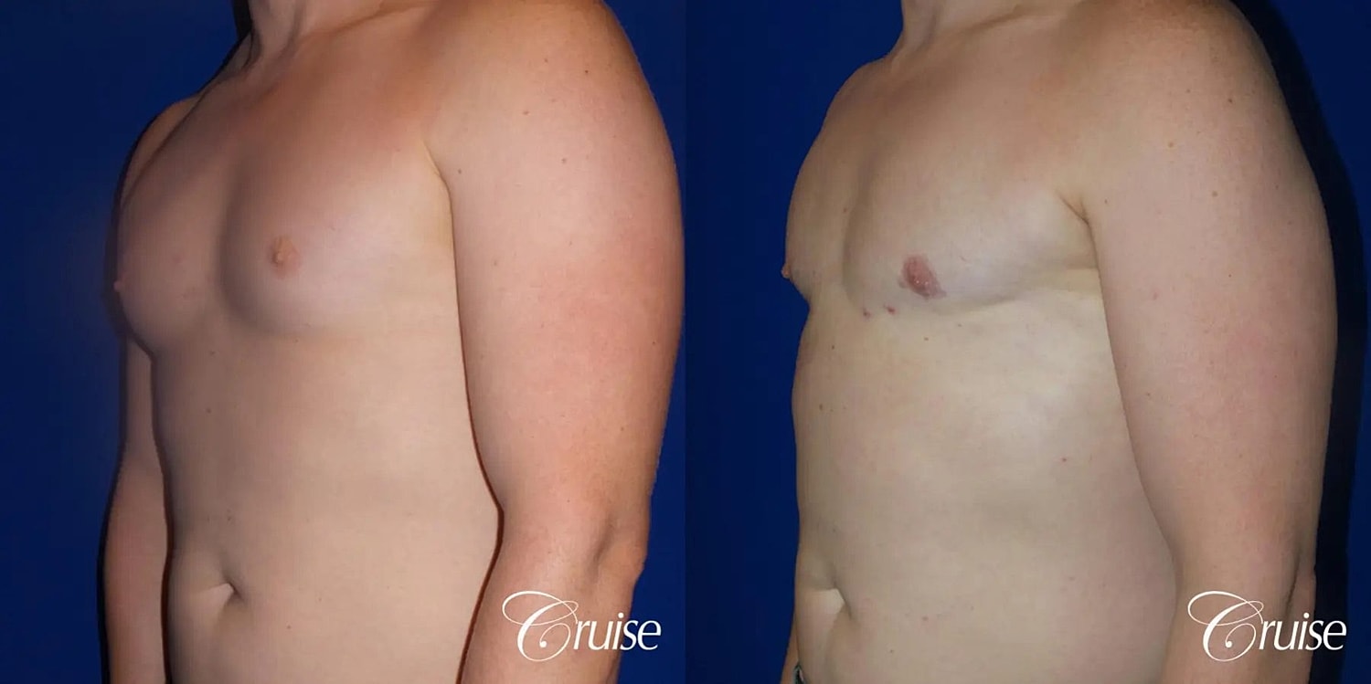 Gynecomastia Surgery Before & After