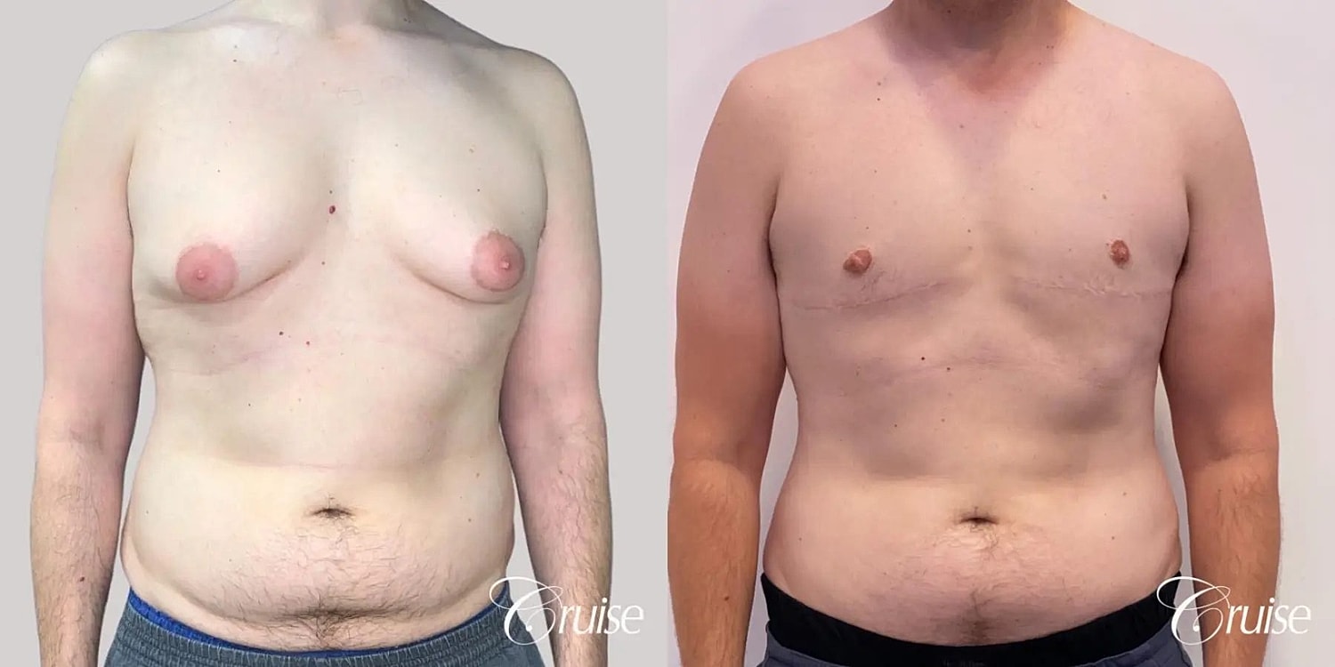 Gynecomastia Surgery Before & After