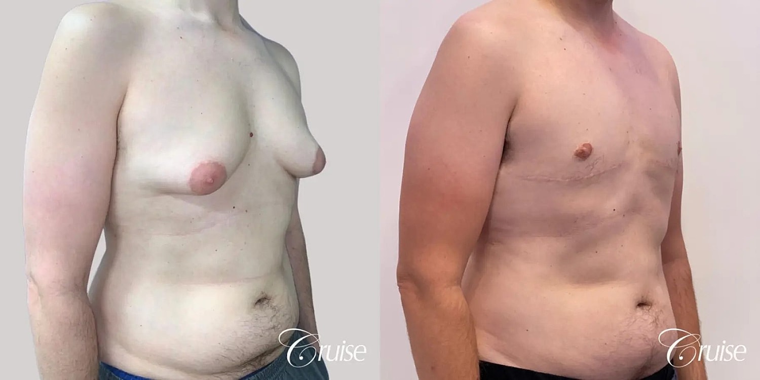 Gynecomastia Surgery Before & After