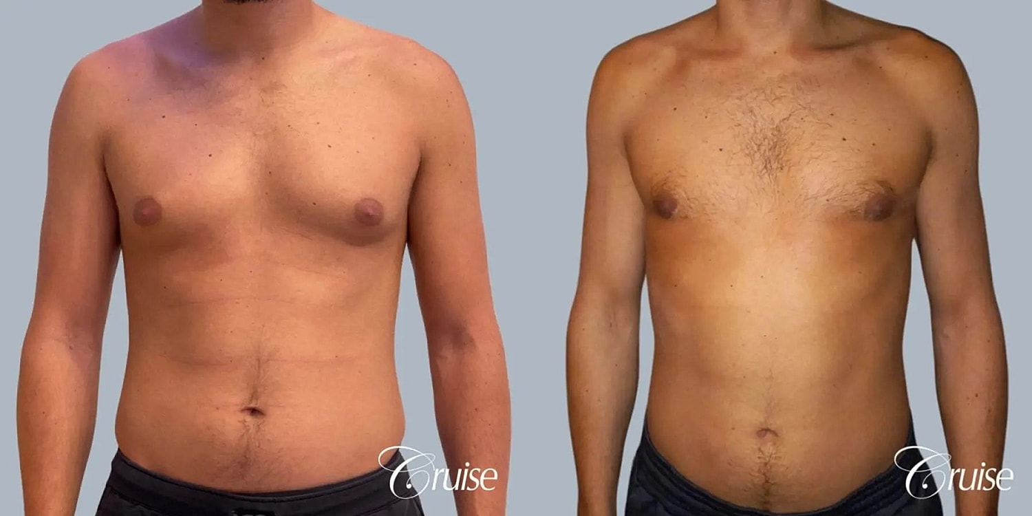 Gynecomastia Surgery Before & After
