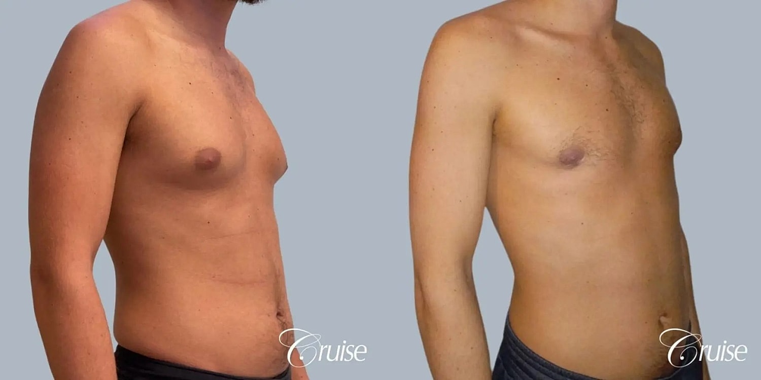 Gynecomastia Surgery Before & After