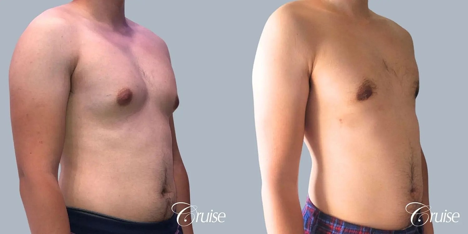 Gynecomastia Surgery Before & After