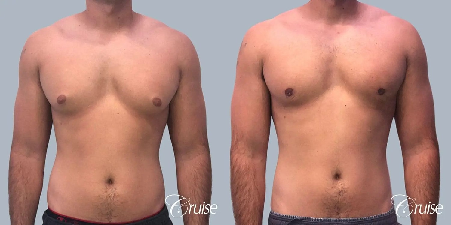 Gynecomastia Surgery Before & After