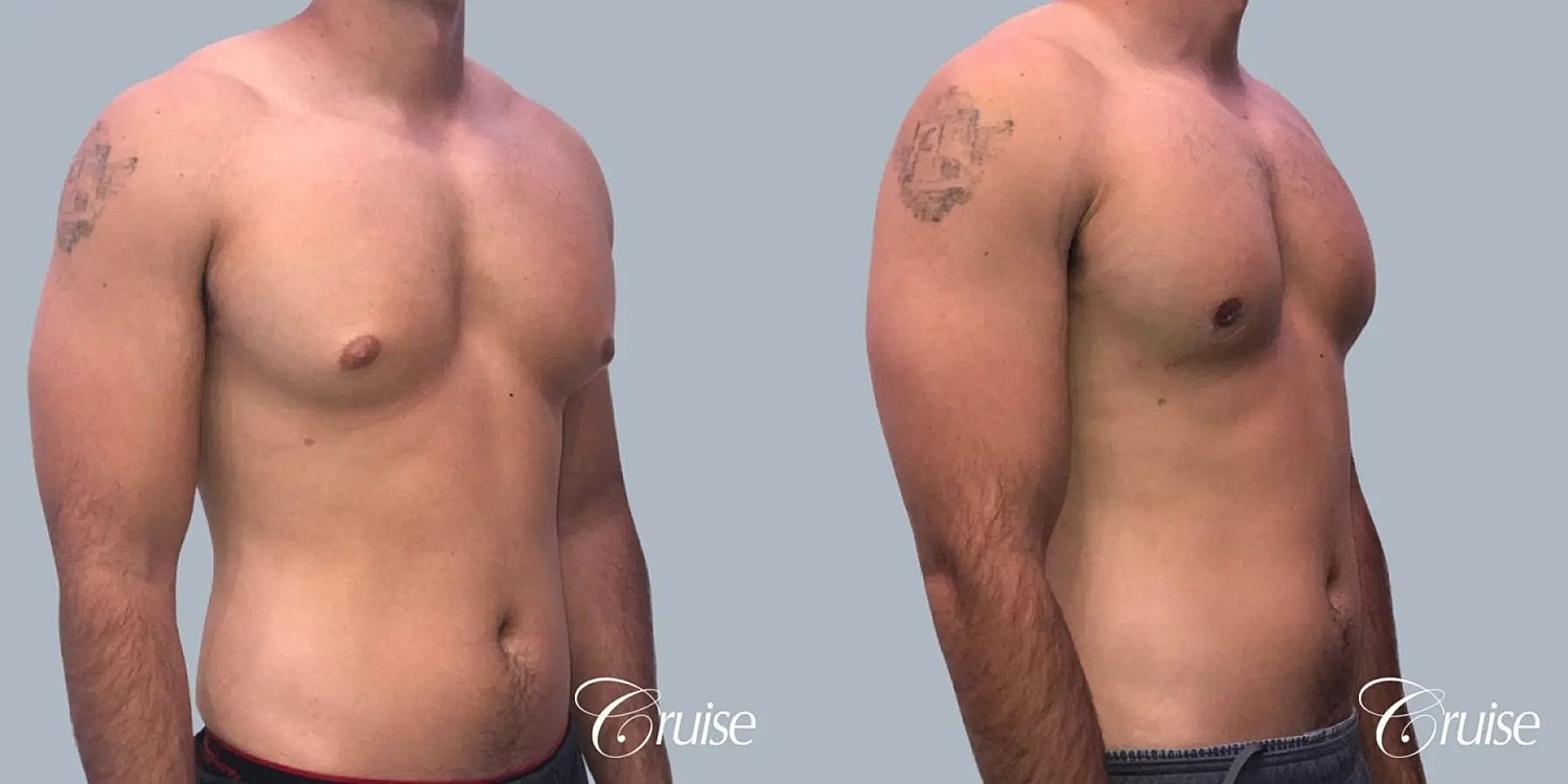 Gynecomastia Surgery Before & After