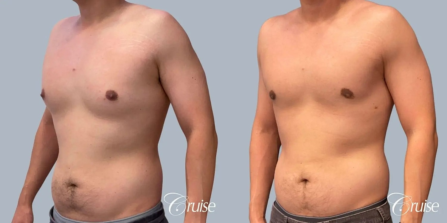 Gynecomastia Surgery Before & After