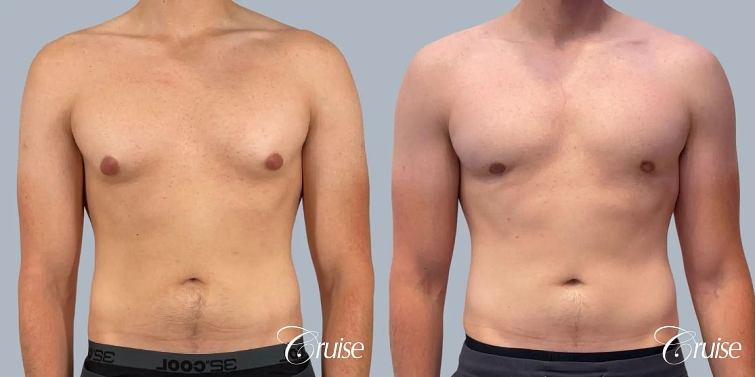 Gynecomastia Surgery Before & After