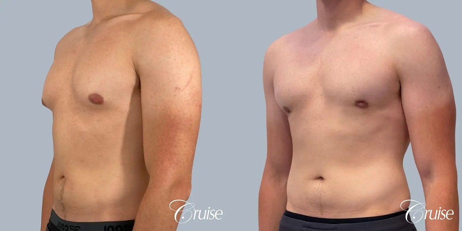 Gynecomastia Surgery Before & After