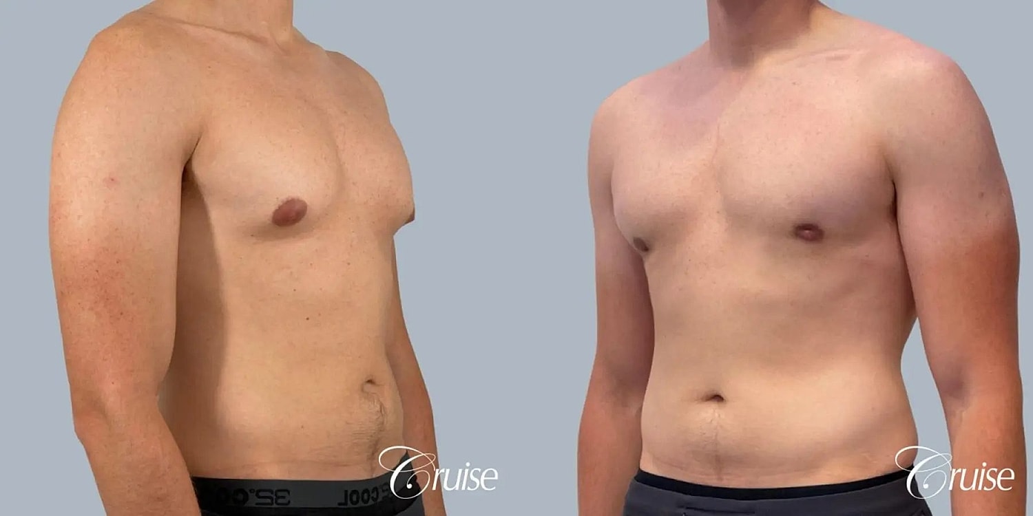 Gynecomastia Surgery Before & After