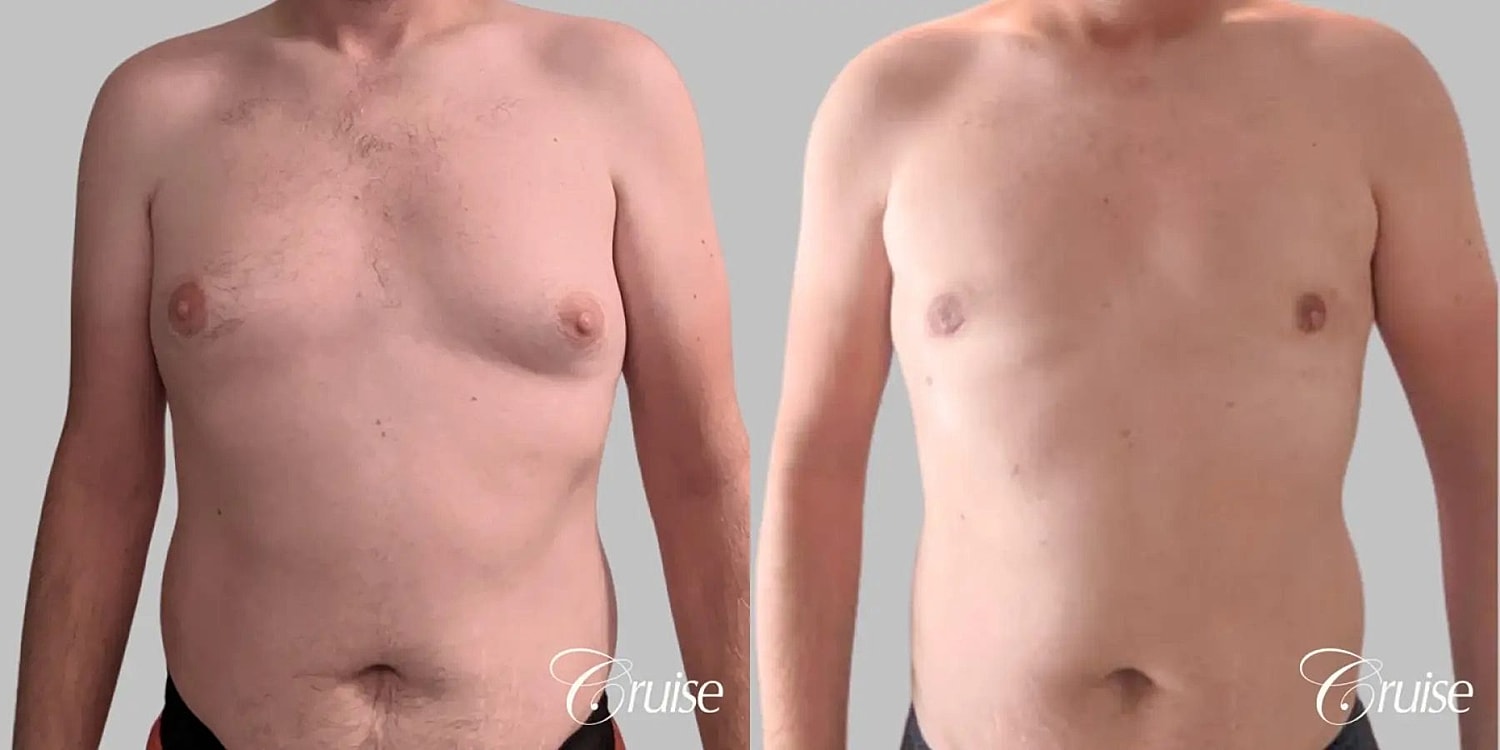 Gynecomastia Surgery Before & After