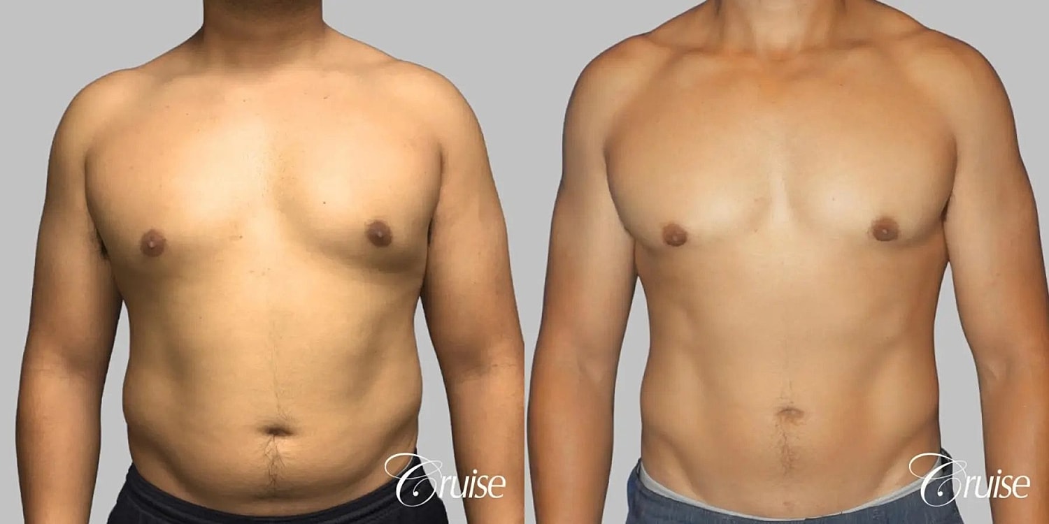 Gynecomastia Surgery Before & After