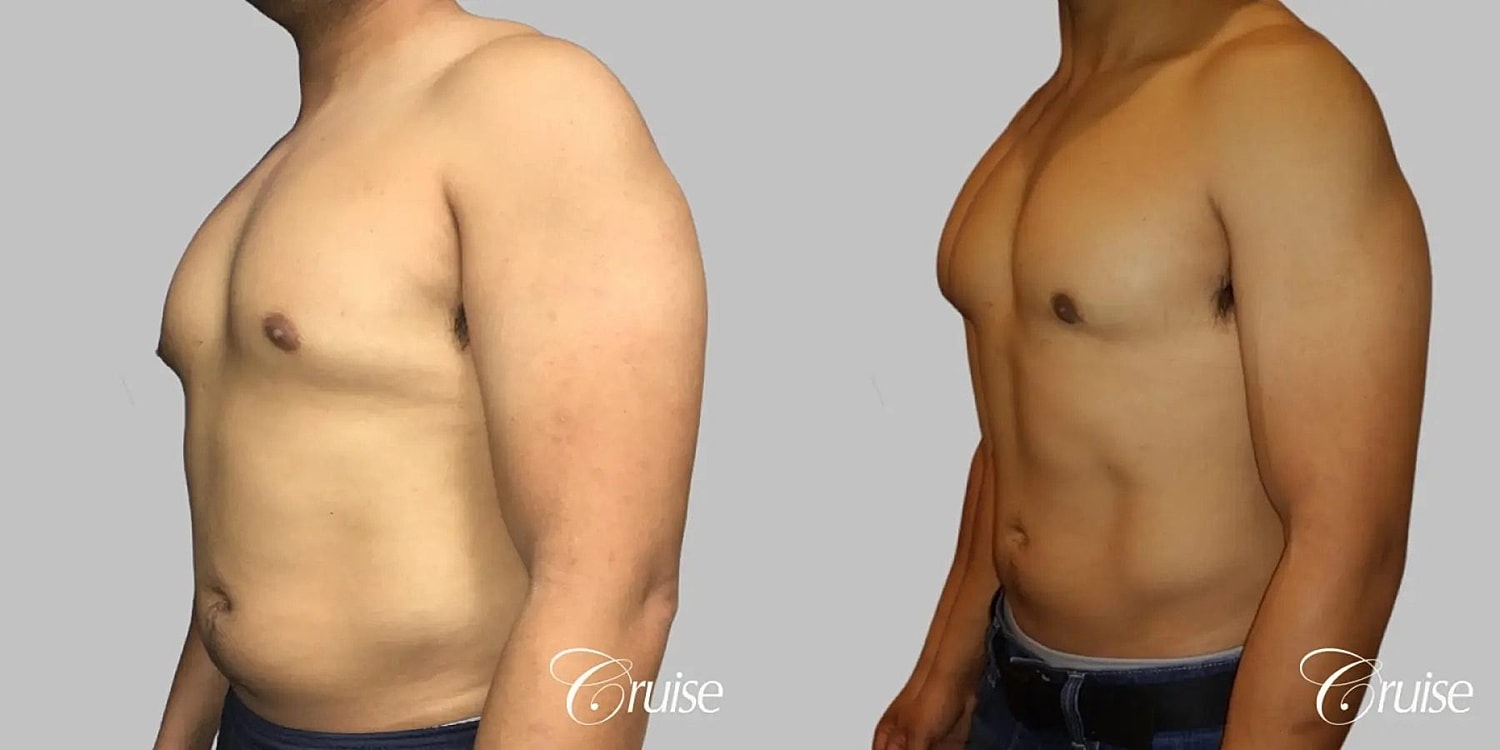 Gynecomastia Surgery Before & After