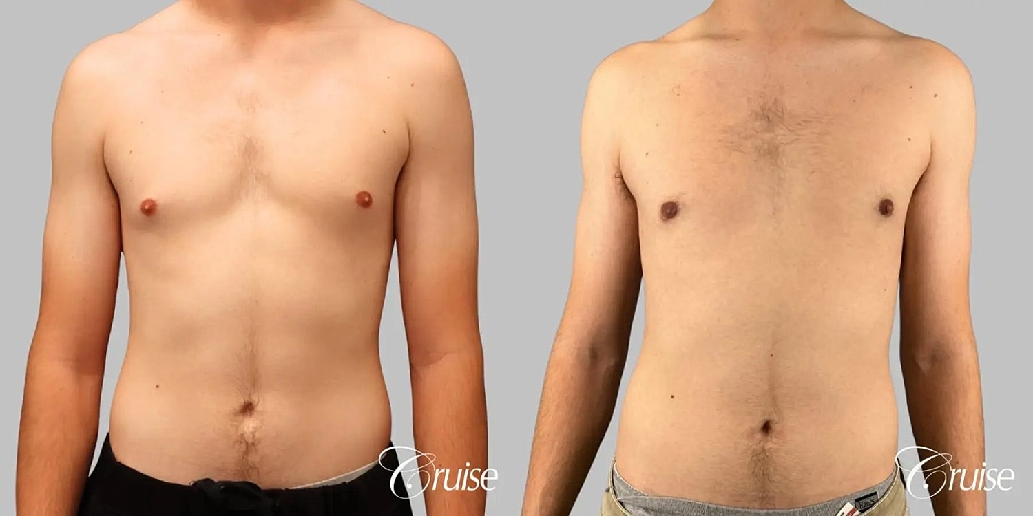 Gynecomastia Surgery Before & After