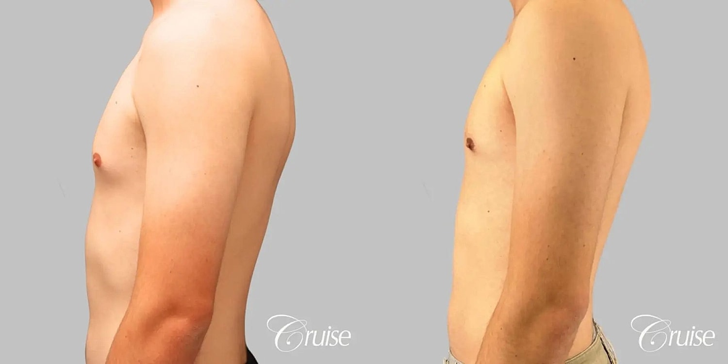 Gynecomastia Surgery Before & After