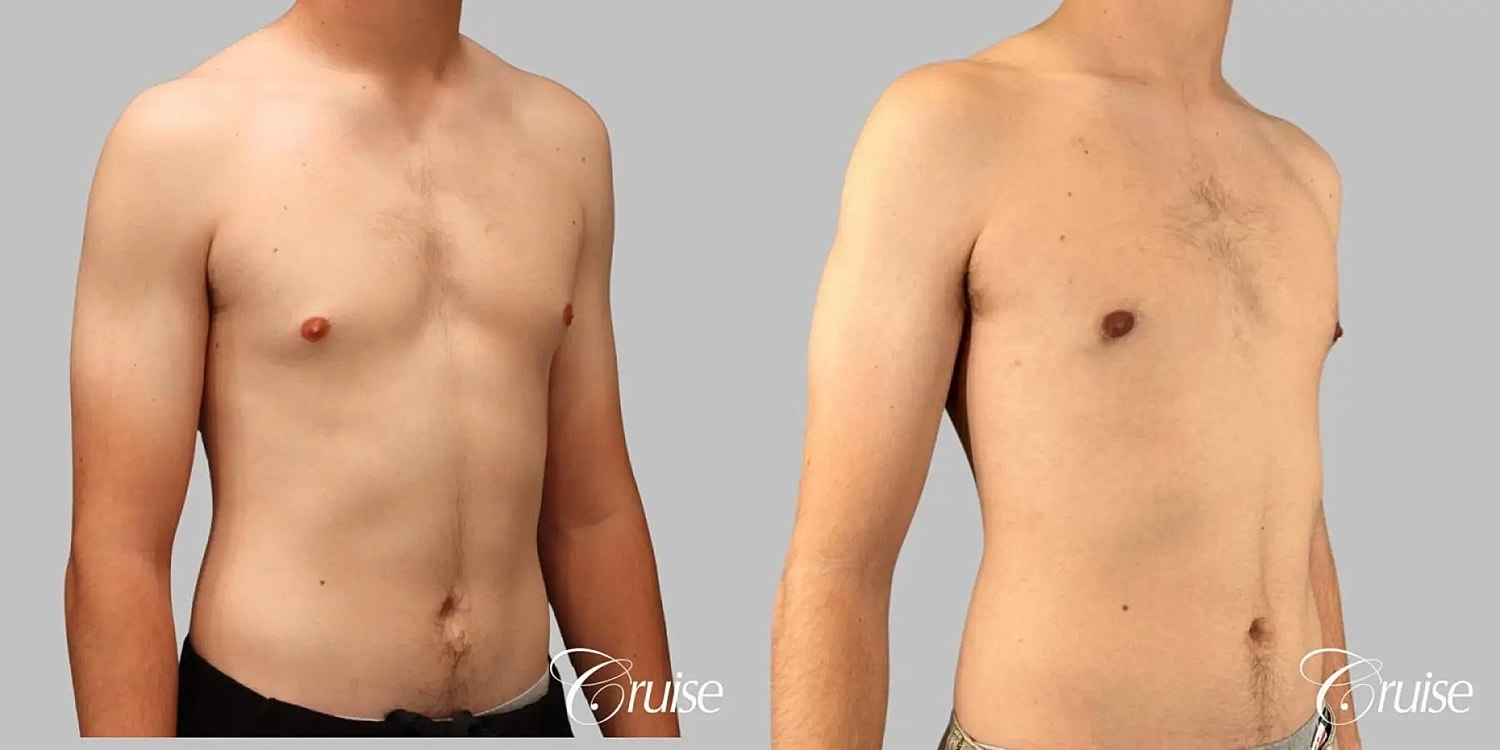 Gynecomastia Surgery Before & After