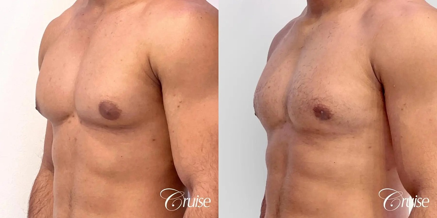 Gynecomastia Surgery Before & After
