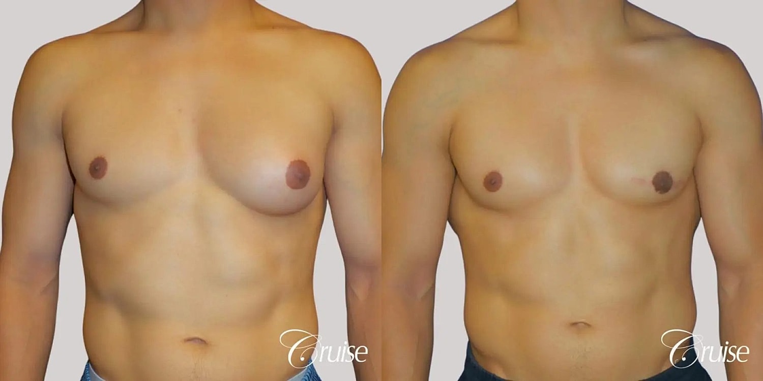 Gynecomastia Surgery Before & After