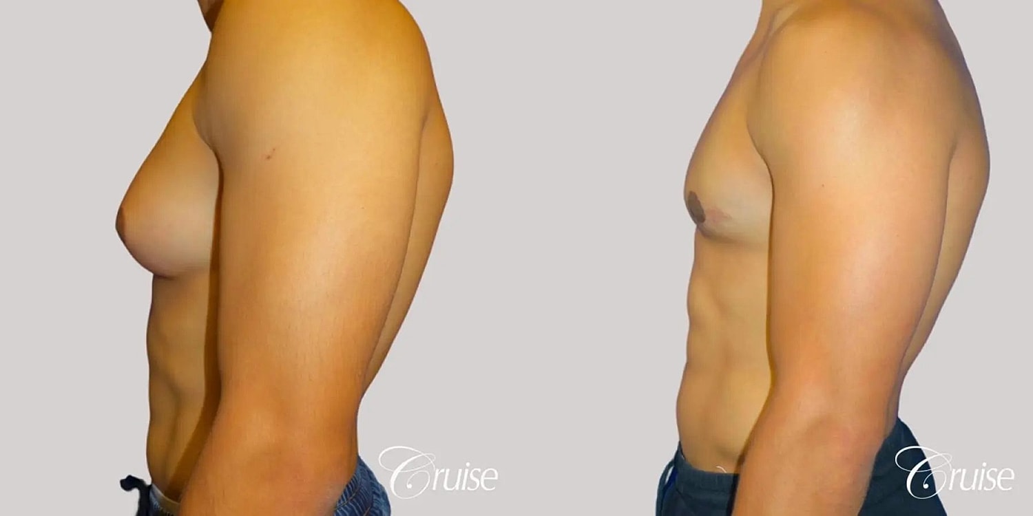 Gynecomastia Surgery Before & After