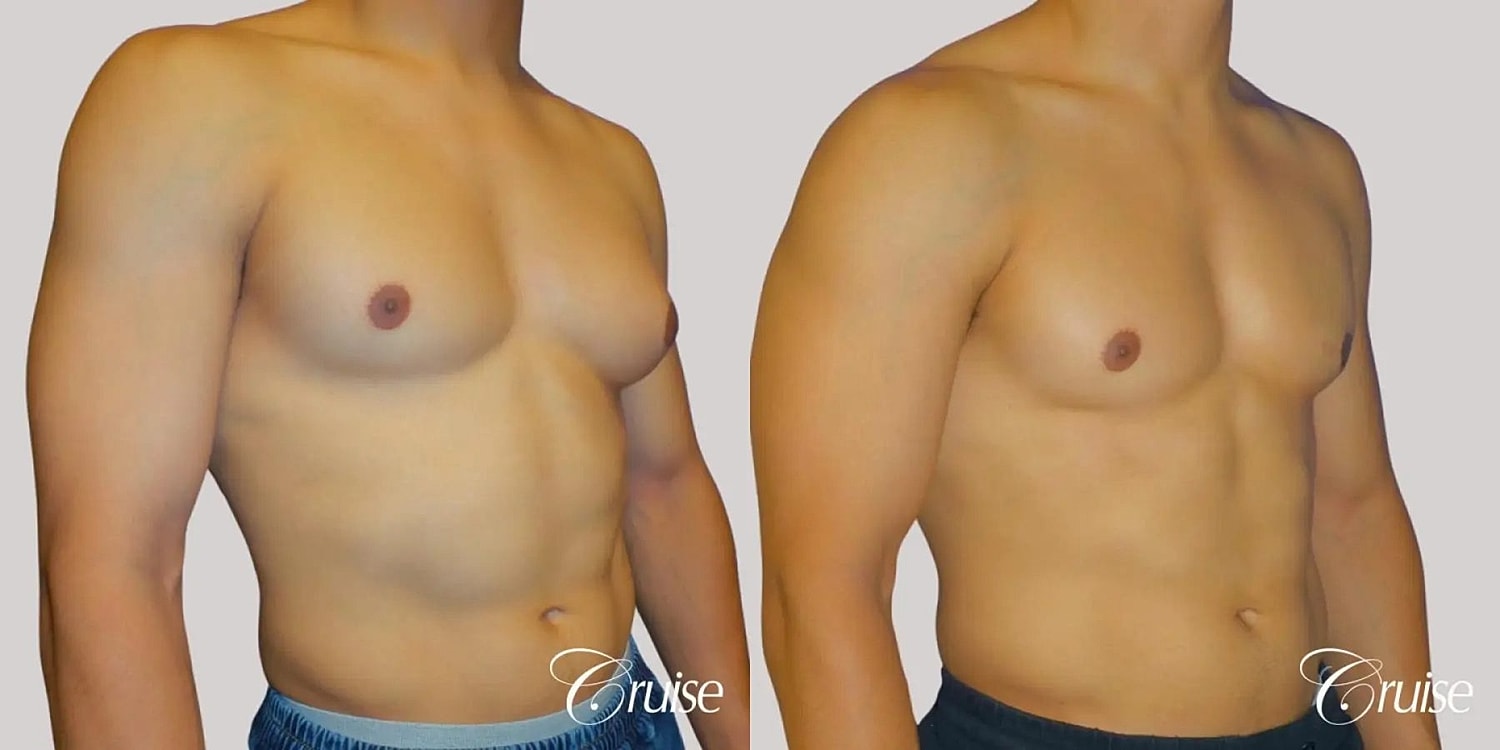 Gynecomastia Surgery Before & After