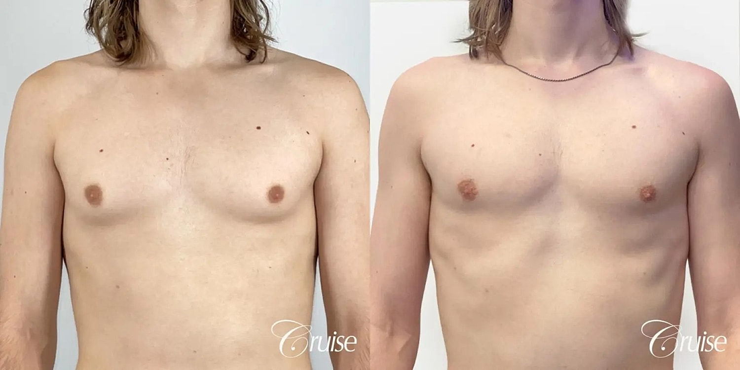 Gynecomastia Surgery Before & After