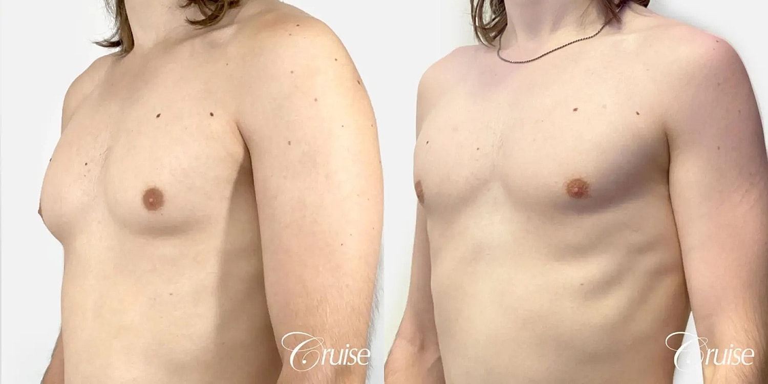 Gynecomastia Surgery Before & After