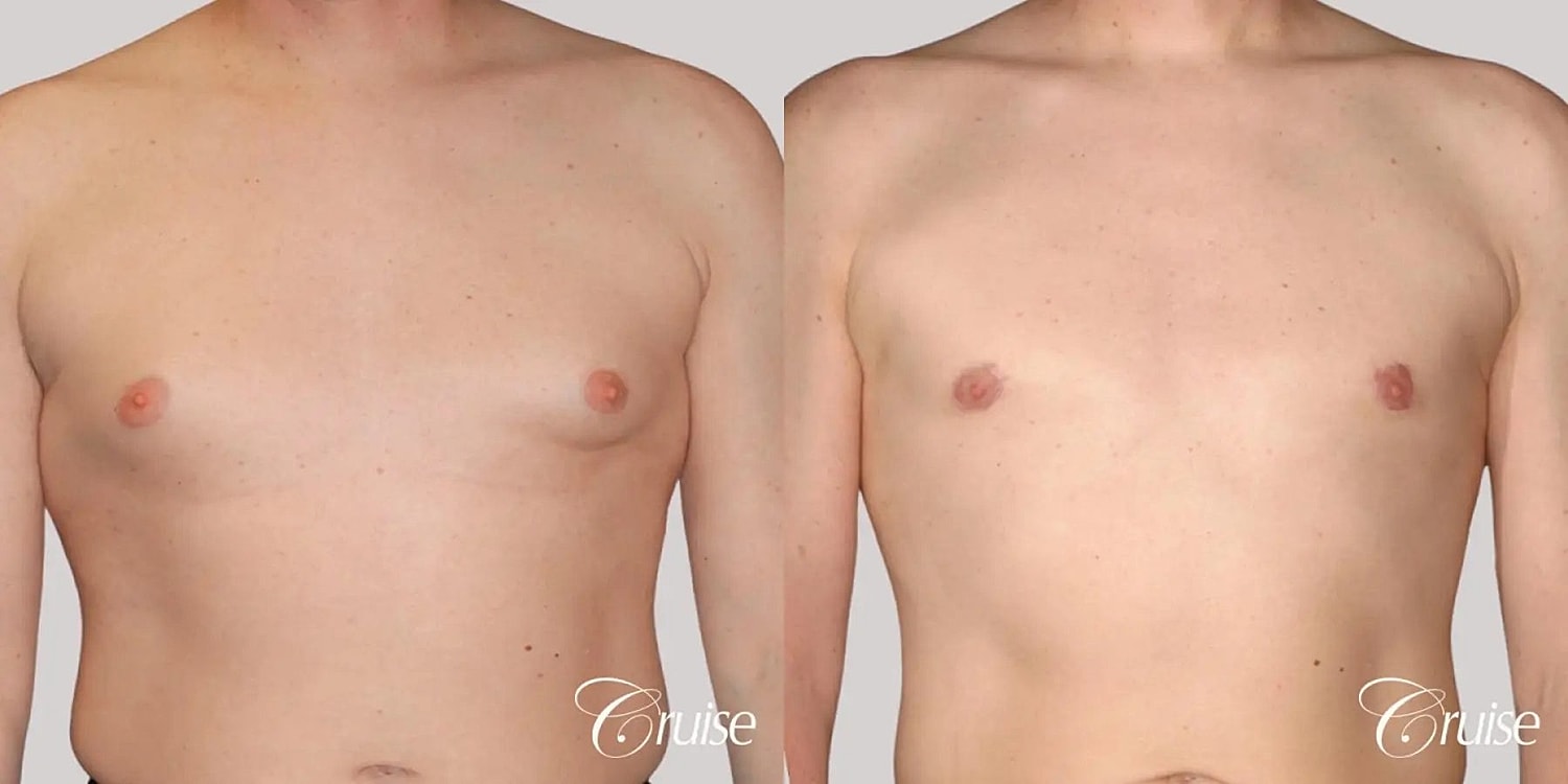 Gynecomastia Surgery Before & After