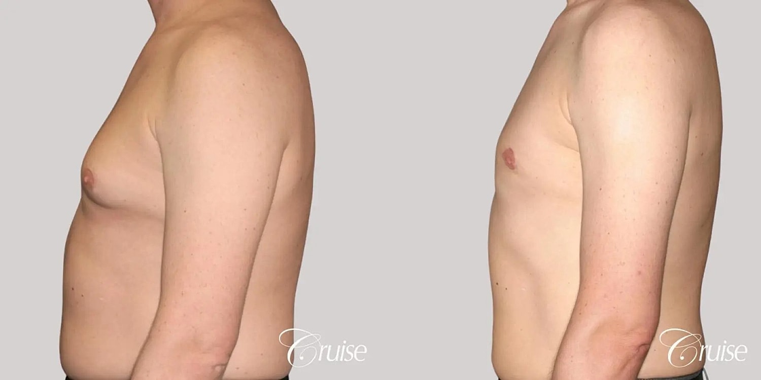 Gynecomastia Surgery Before & After