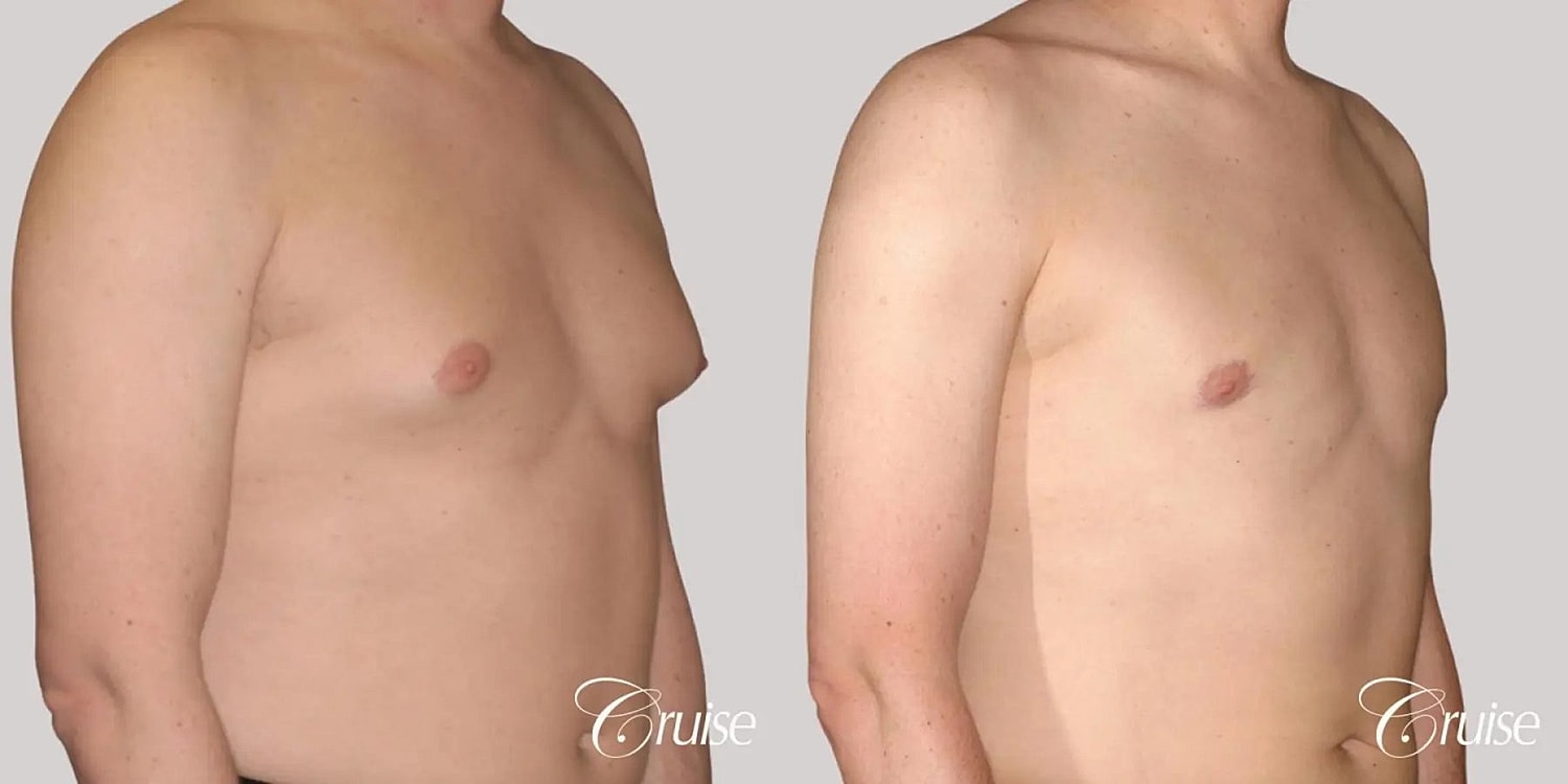 Gynecomastia Surgery Before & After