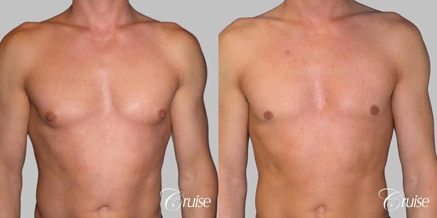 Gynecomastia Surgery Before & After