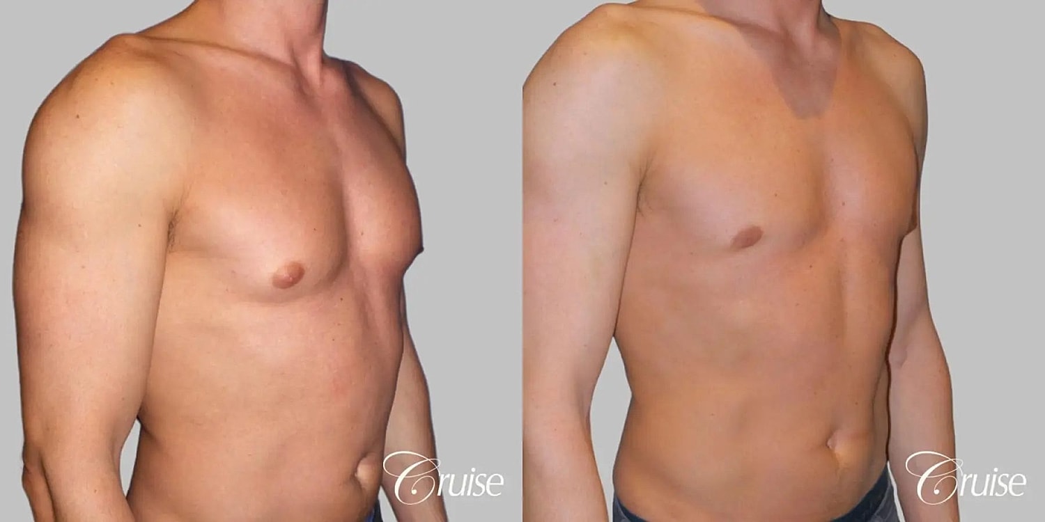 Gynecomastia Surgery Before & After