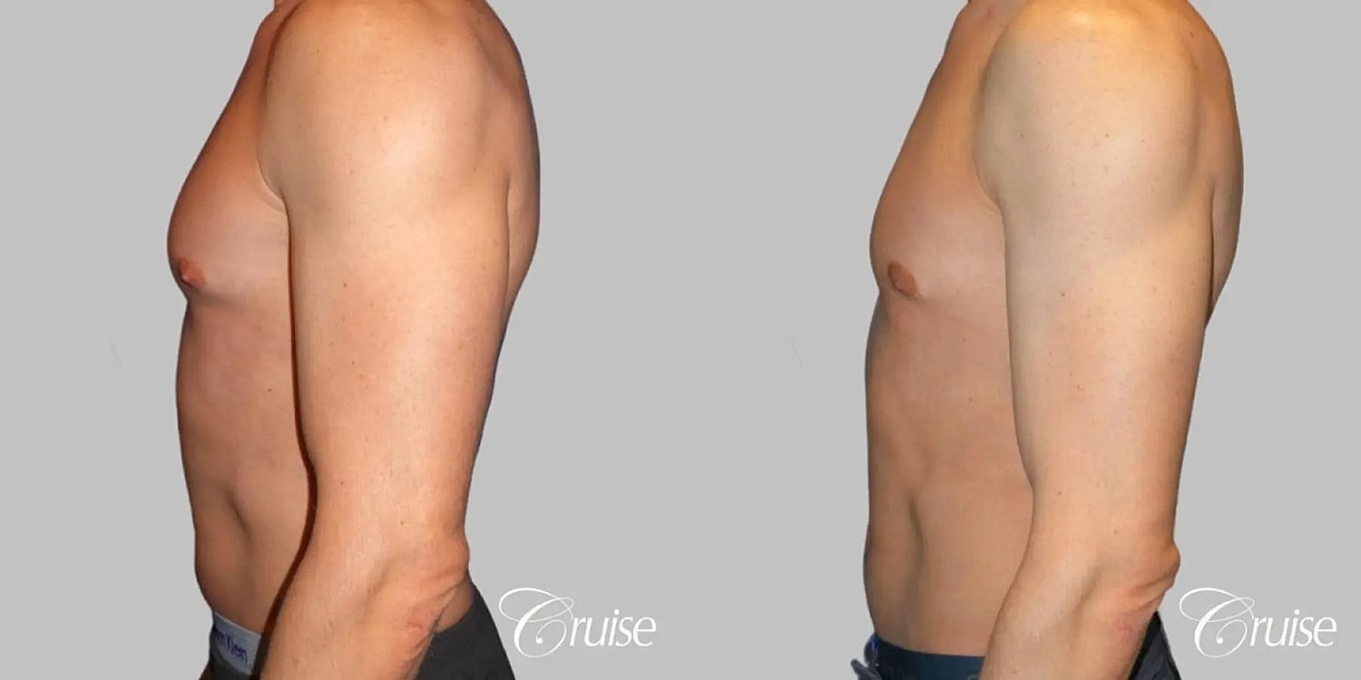 Gynecomastia Surgery Before & After
