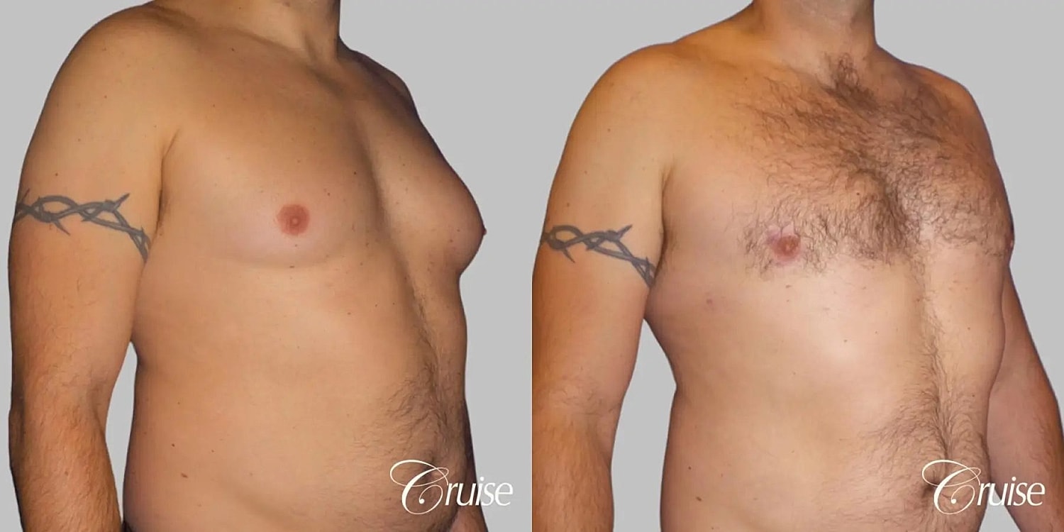 Gynecomastia Surgery Before & After