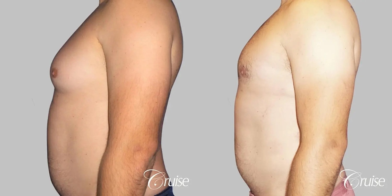 Gynecomastia Surgery Before & After