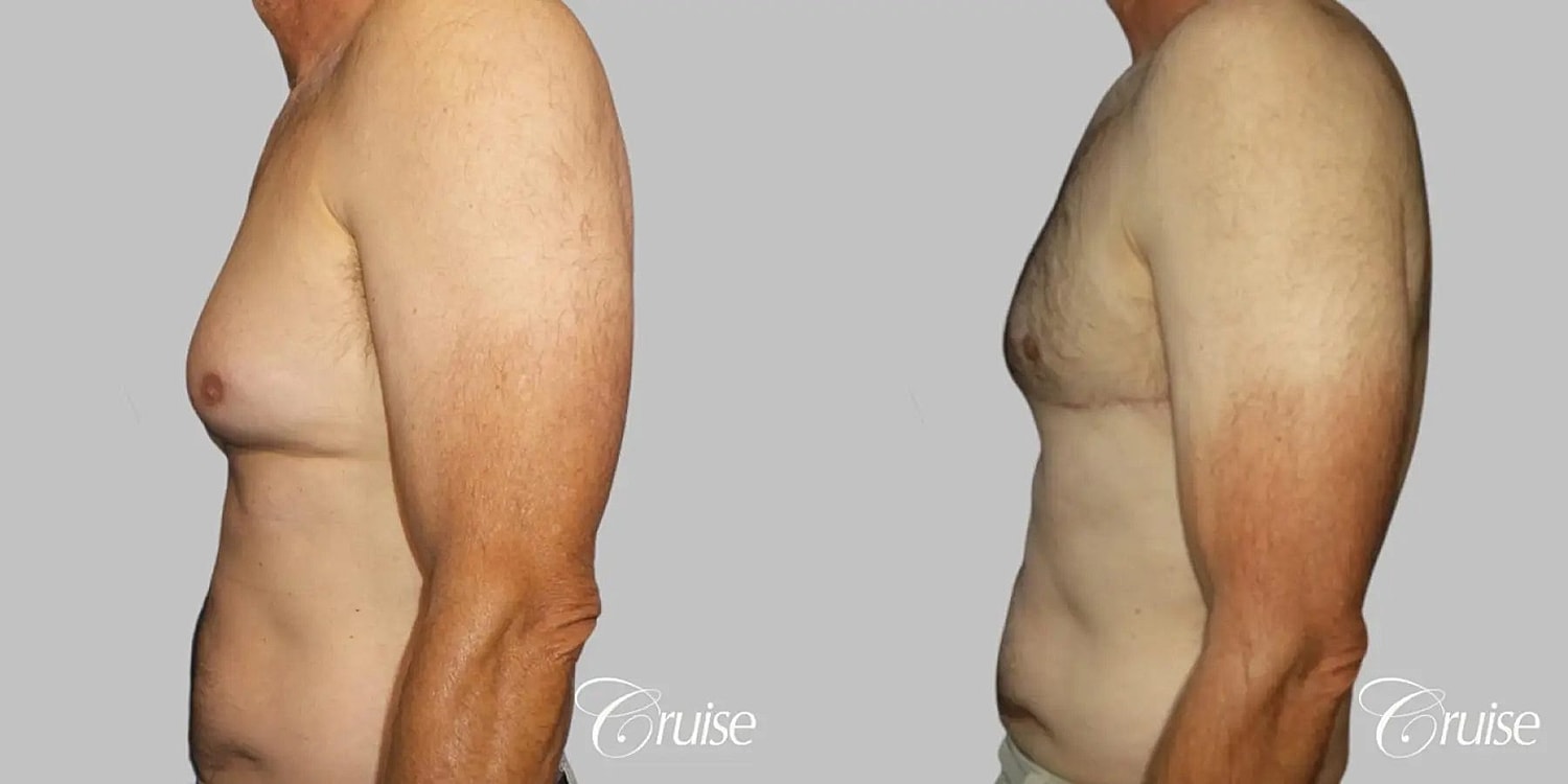 Gynecomastia Surgery Before & After